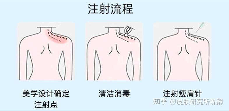 瘦脸针注射位置图图片