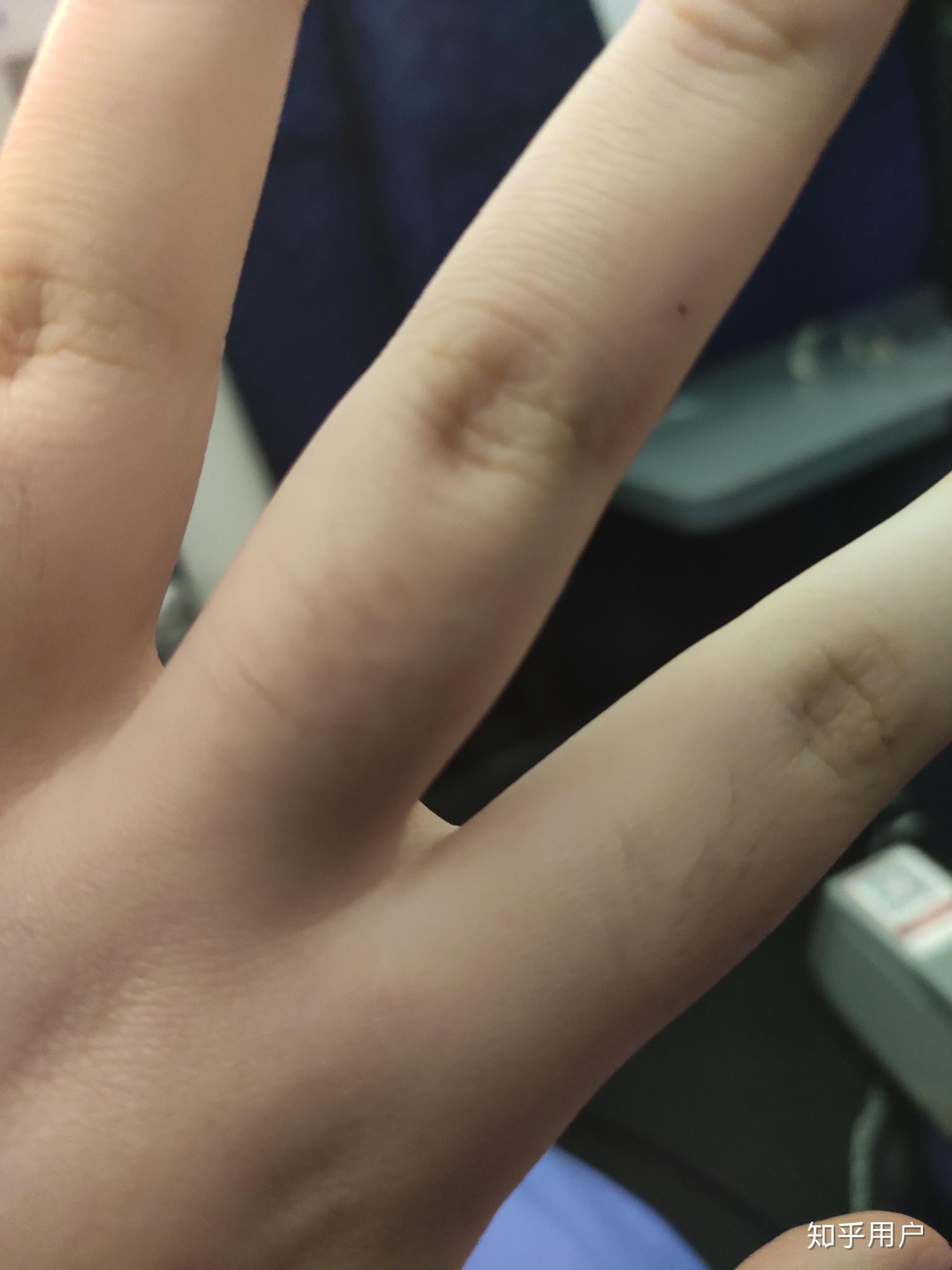 女生右手中指突然长了个小痣代表什麼? - 知乎
