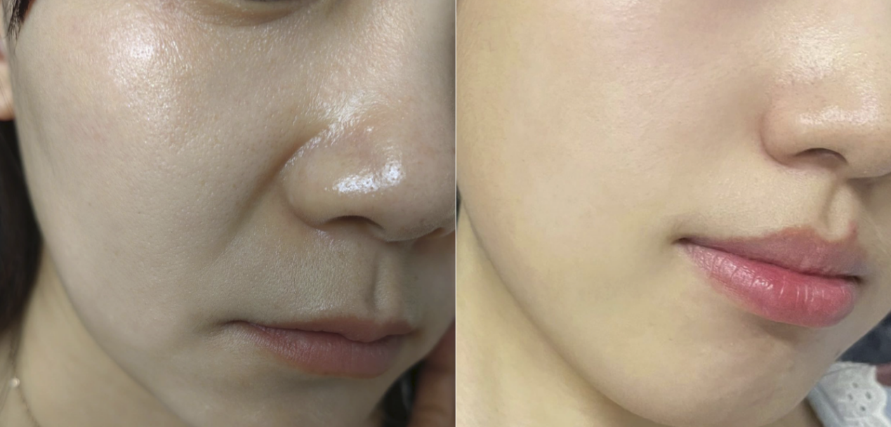 内娱女明星都在练的“嘟嘴大法”,真的能消法令纹?最适合普通人的抗老方式是什么? - 知乎