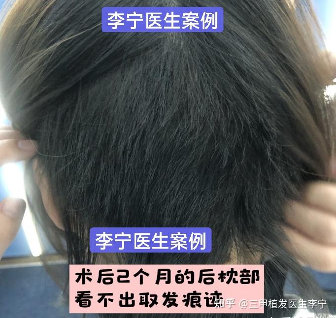疤痕植发