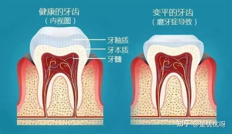 夜磨牙到底是什么原因造成的? - 知乎