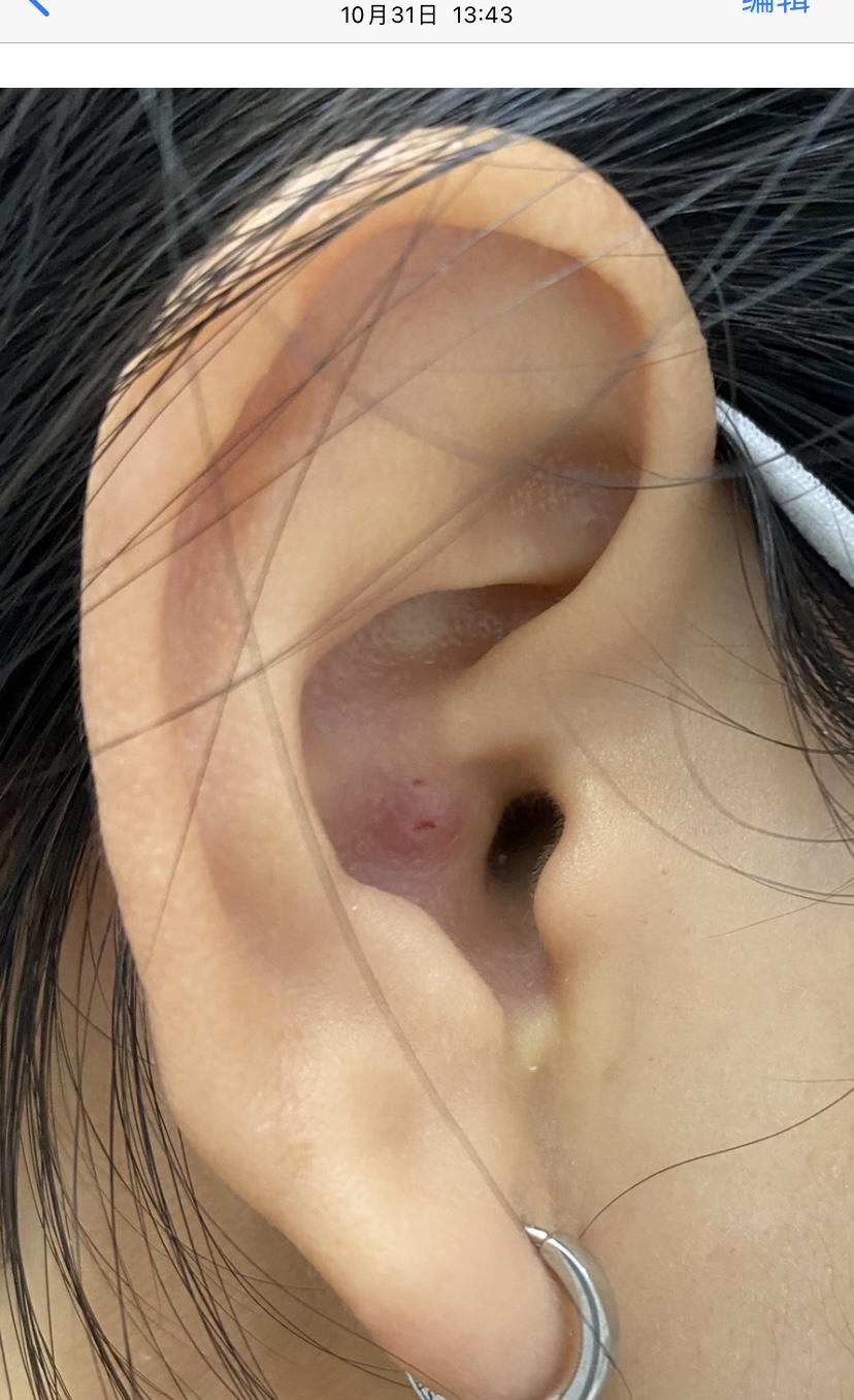 怎样对付外耳道的疖肿? - 知乎