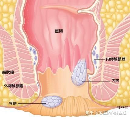 長痔瘡的原因是什麼