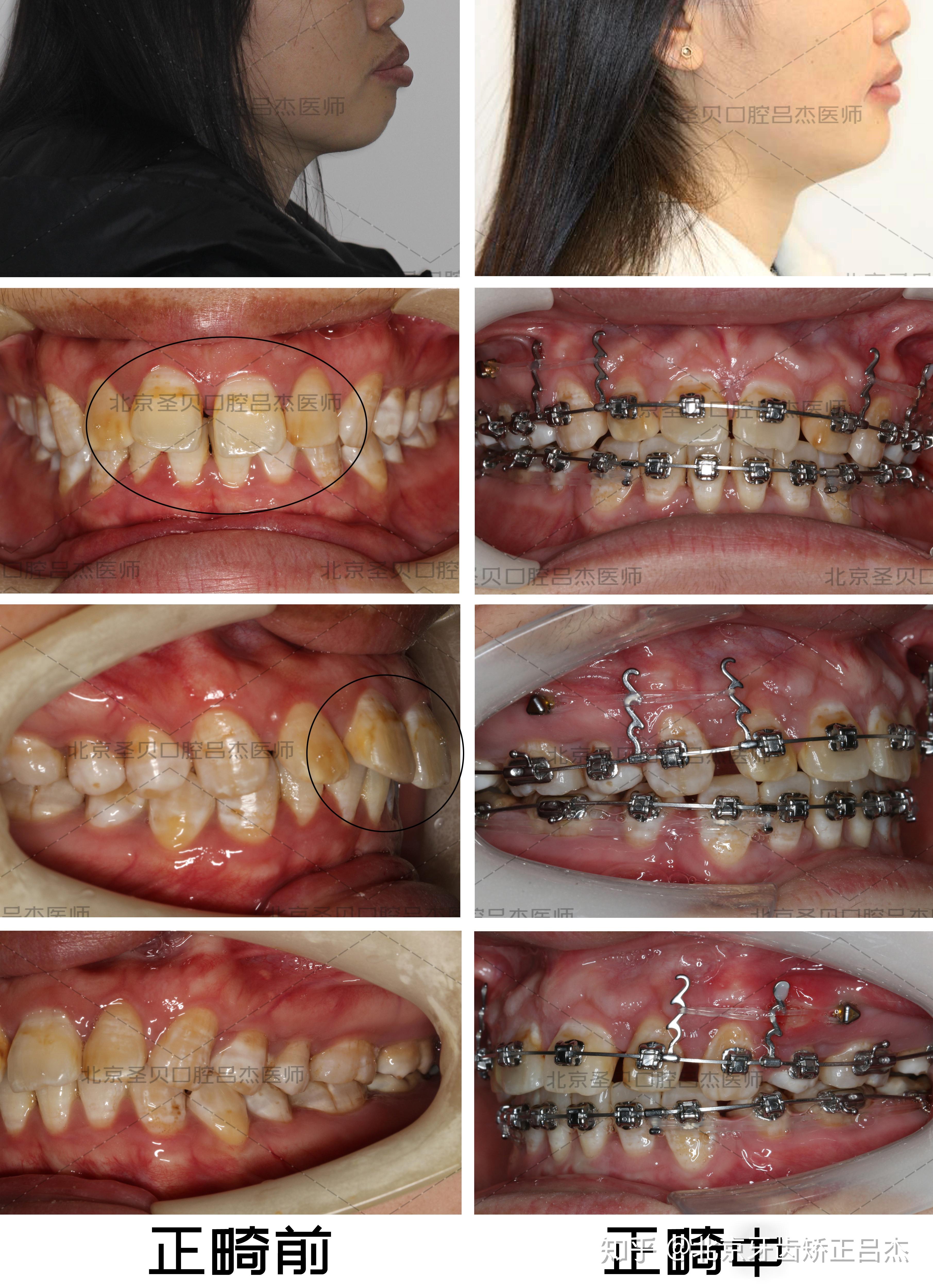 矫正牙齿对脸型的影响大吗
