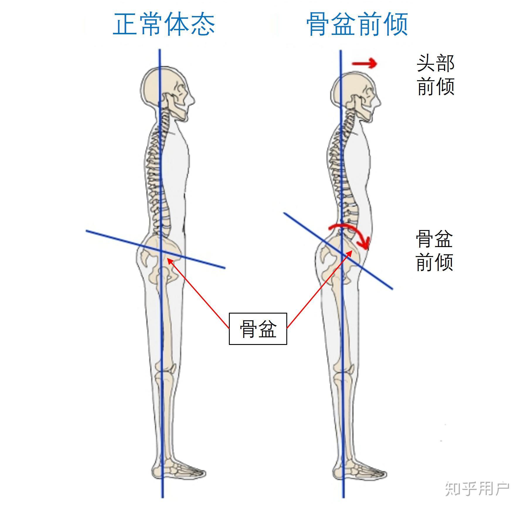 腰椎曲度僵直、过度前凸？2个动作告别腰痛、紧致小腹、恢复脊柱的正常曲度_哔哩哔哩_bilibili
