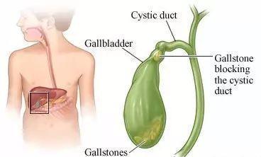 药剂师学习笔记之急性胆囊炎和胆管炎 Cholangitis And Cholecystitis 知乎