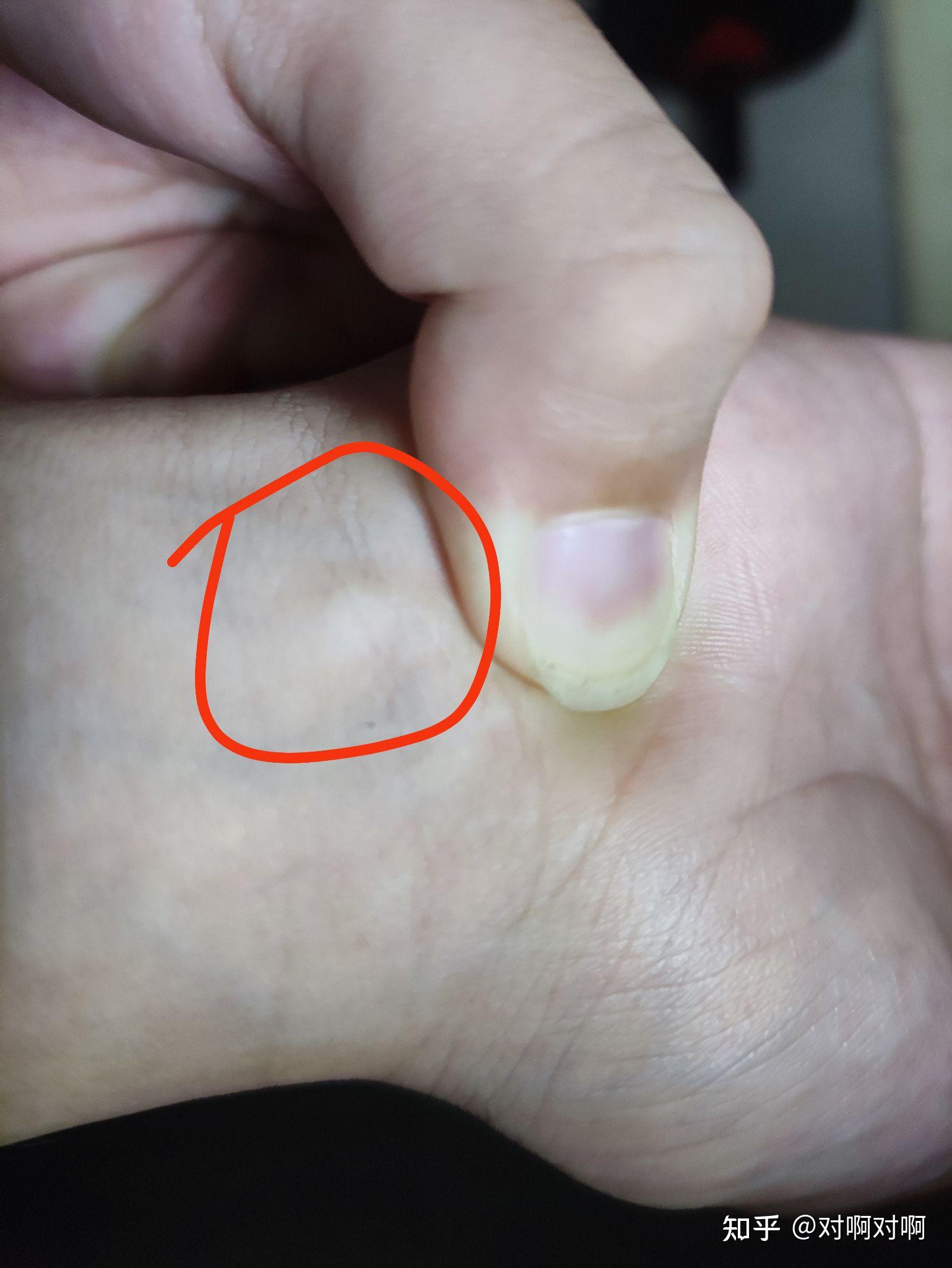 按压手掌靠手腕下方鼓起的两个小包是什么