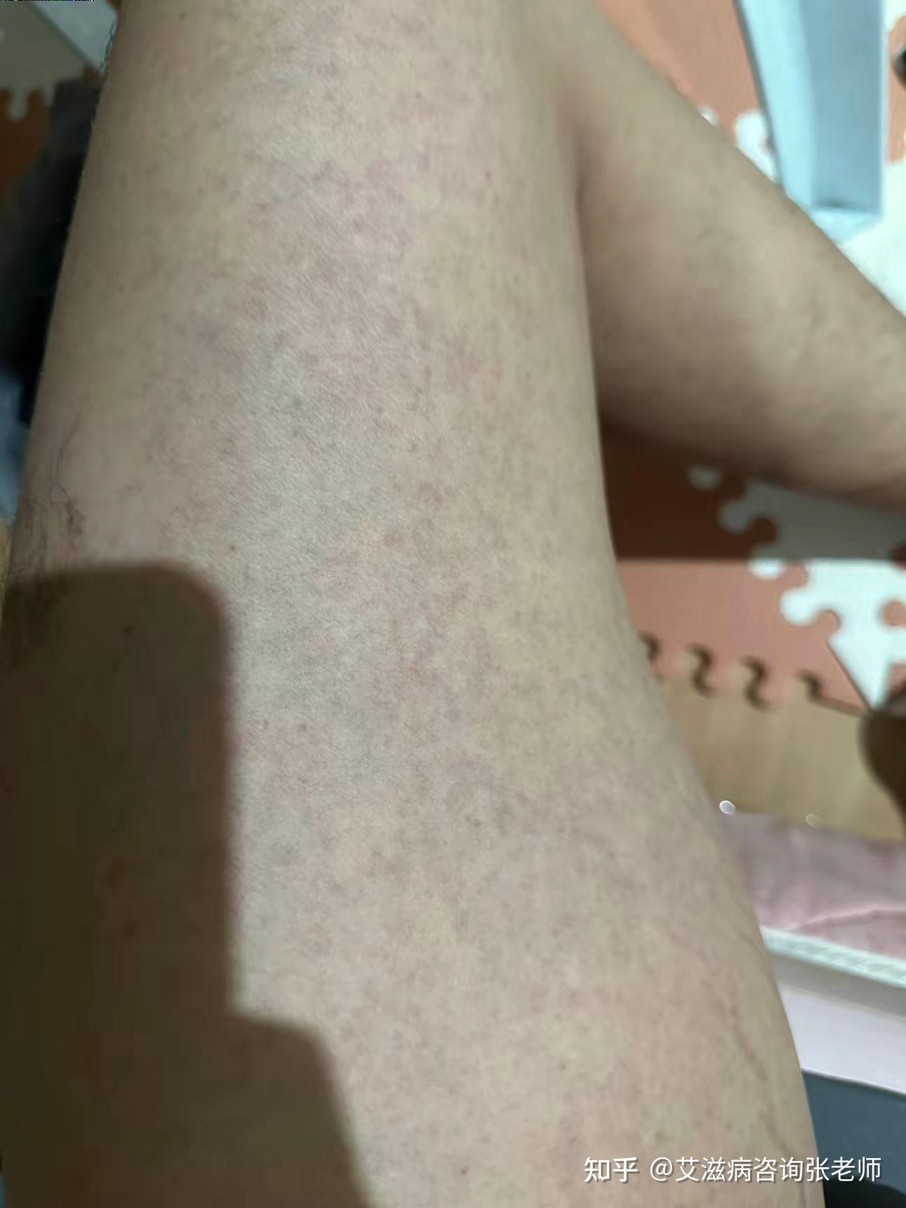 艾滋病前期是什么样子的?