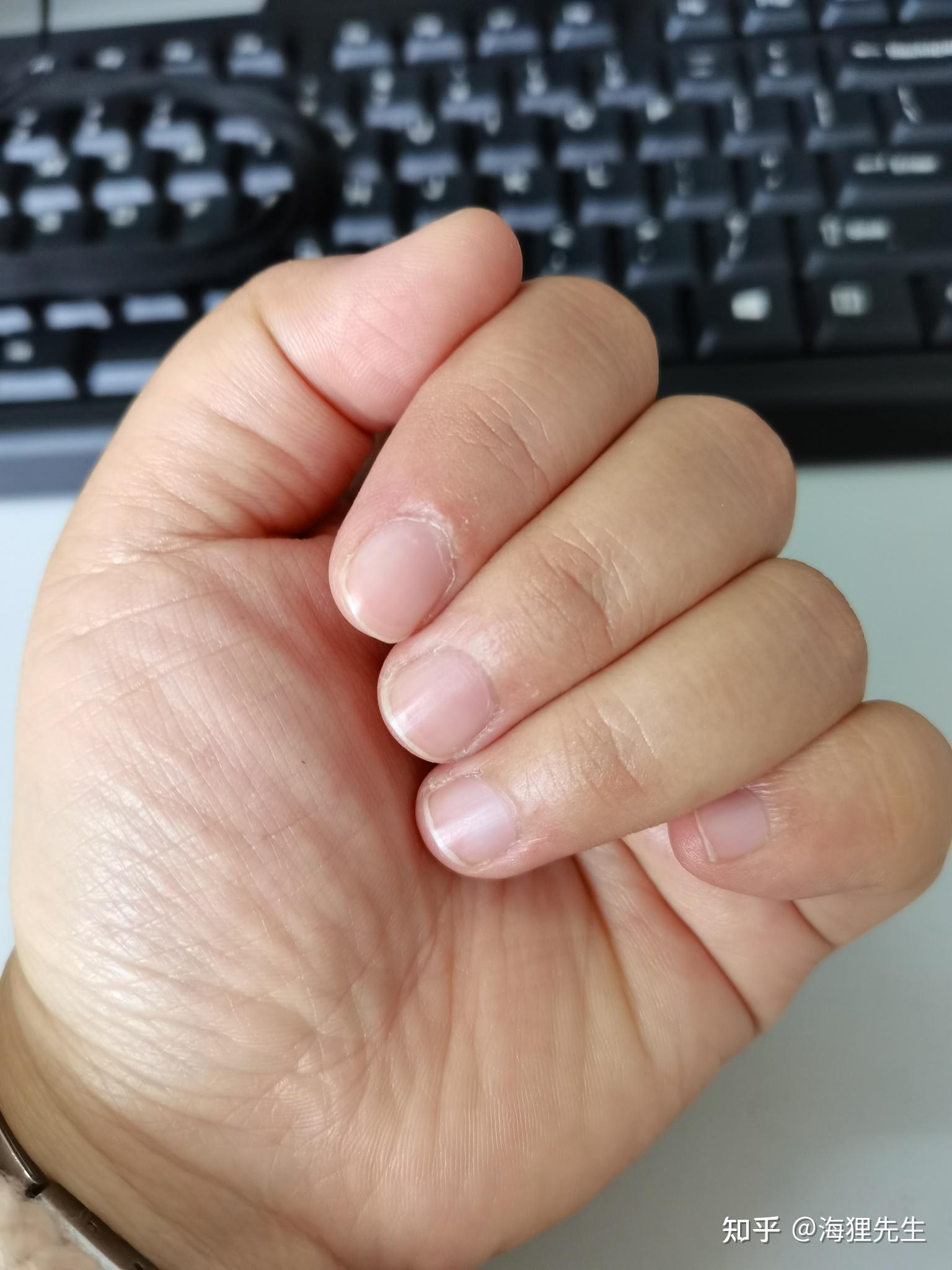 手胖是一种怎样的体验