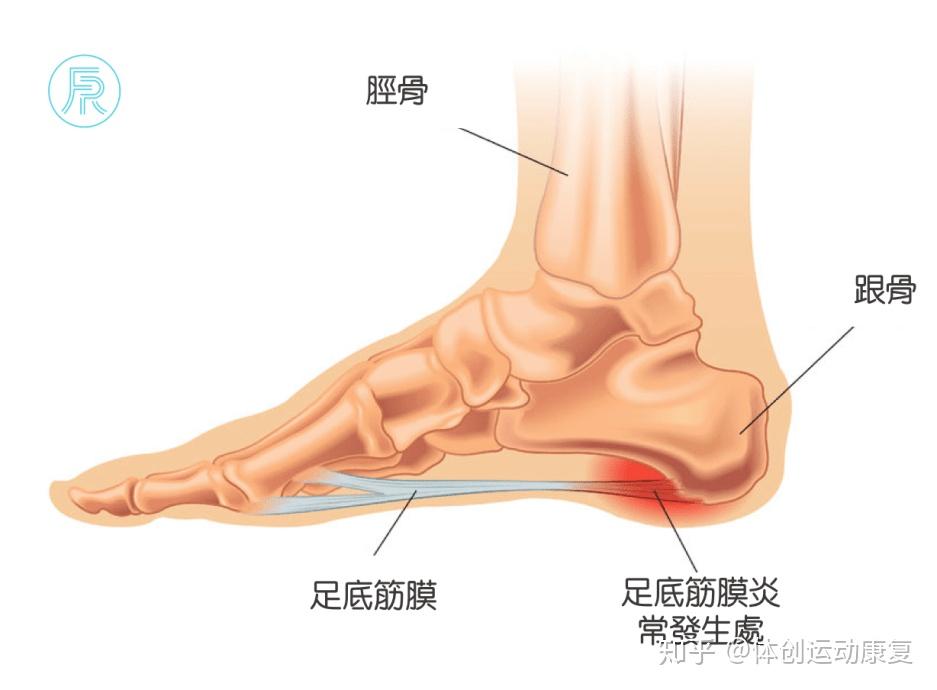 早晨刚起床时走路脚弓疼是怎么回事? 