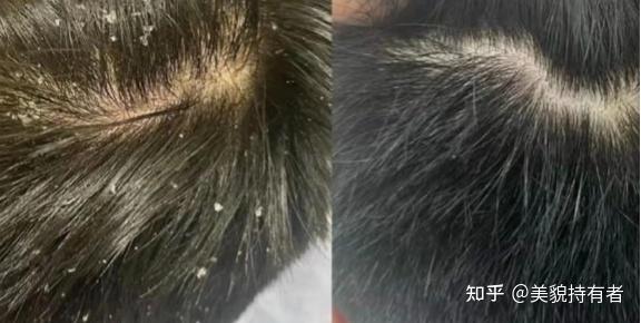 见过最大的头皮屑有多大? - 知乎