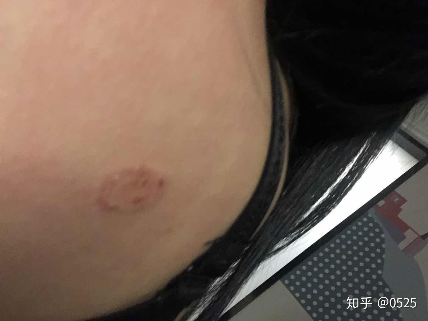 人如果得了猫癣怎么办