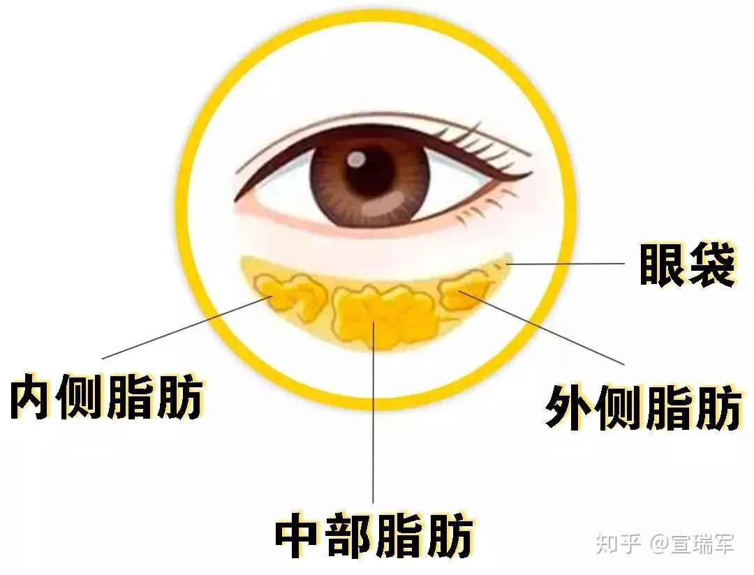 北京内路祛眼袋+眶隔脂肪释放术后分享 - 知乎