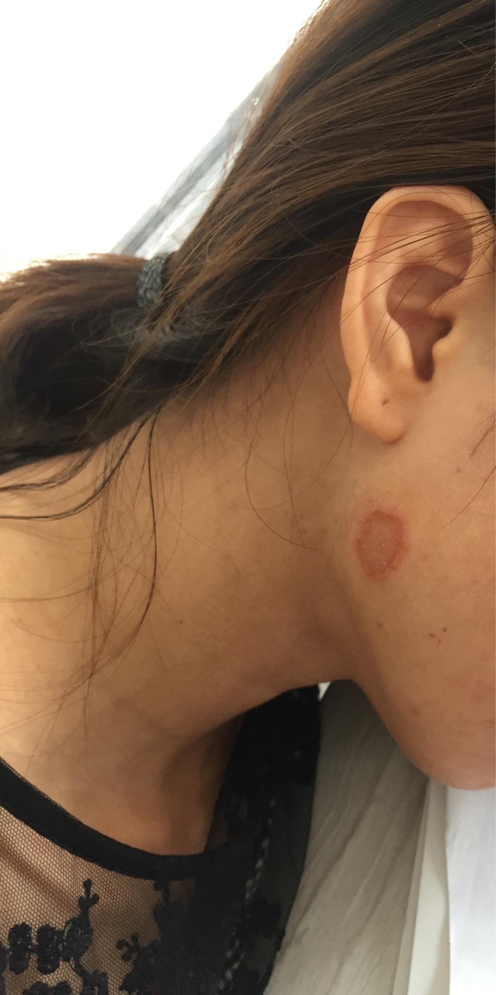 人得了猫藓怎么办