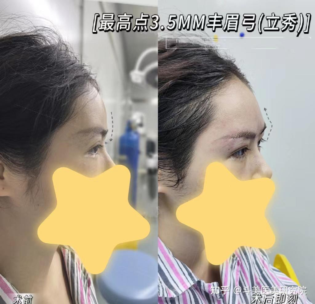 想填充眉弓,是选择假体填充还是玻尿酸填充比较好?填充眉弓要多少钱?国内有哪些填充眉弓审美比较好的医生?