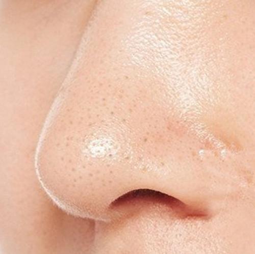 一,黑头的本质是什么?