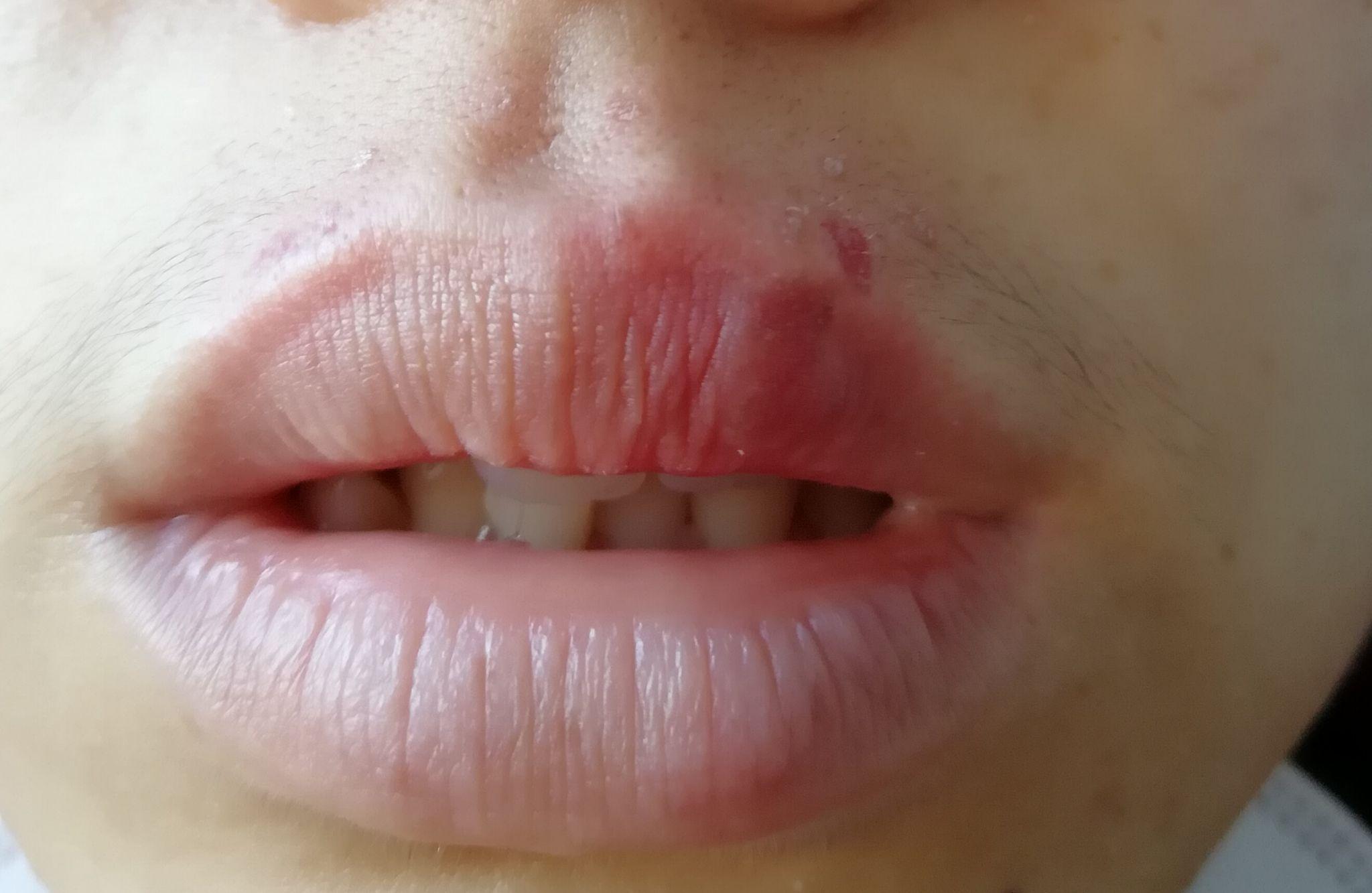嘴唇上最近长了几个黑点像痣又像斑怎么能去除