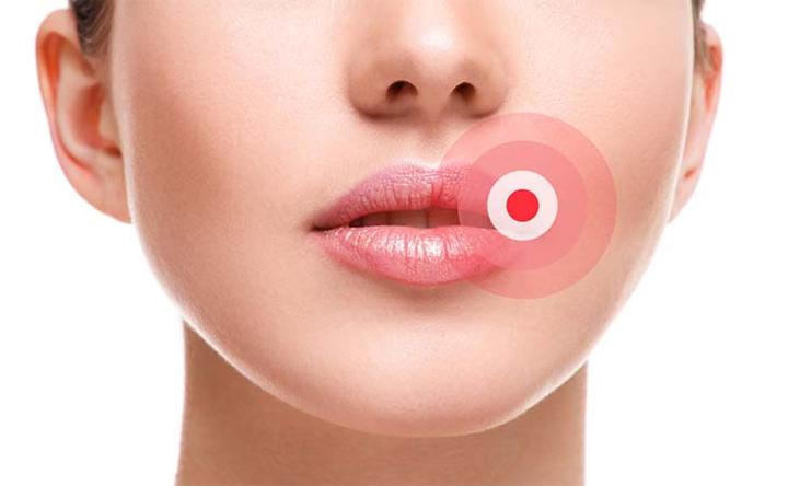 药剂师学习笔记之唇疱疹(cold sores)