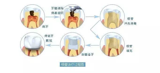 根管治疗步骤是什么?有哪些注意事项? - 知乎
