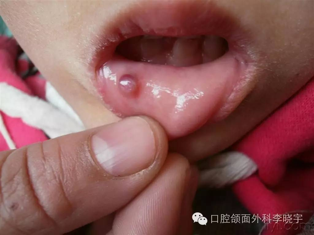 按压下嘴唇时可以摸到若干硬块是正常的情况吗