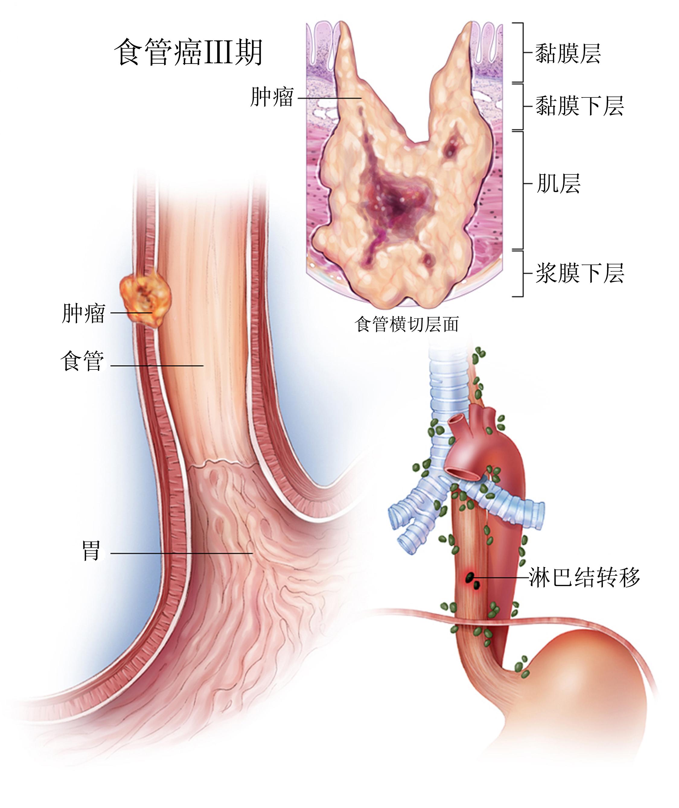 食道癌长在什么部位图图片