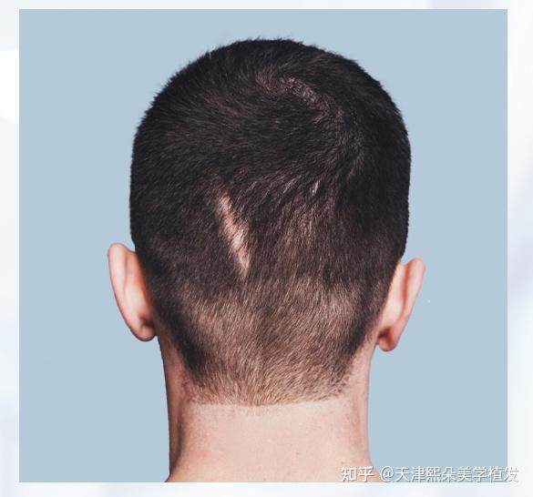不开玩笑,头上有疤痕最好的解决方法是植发! - 知乎