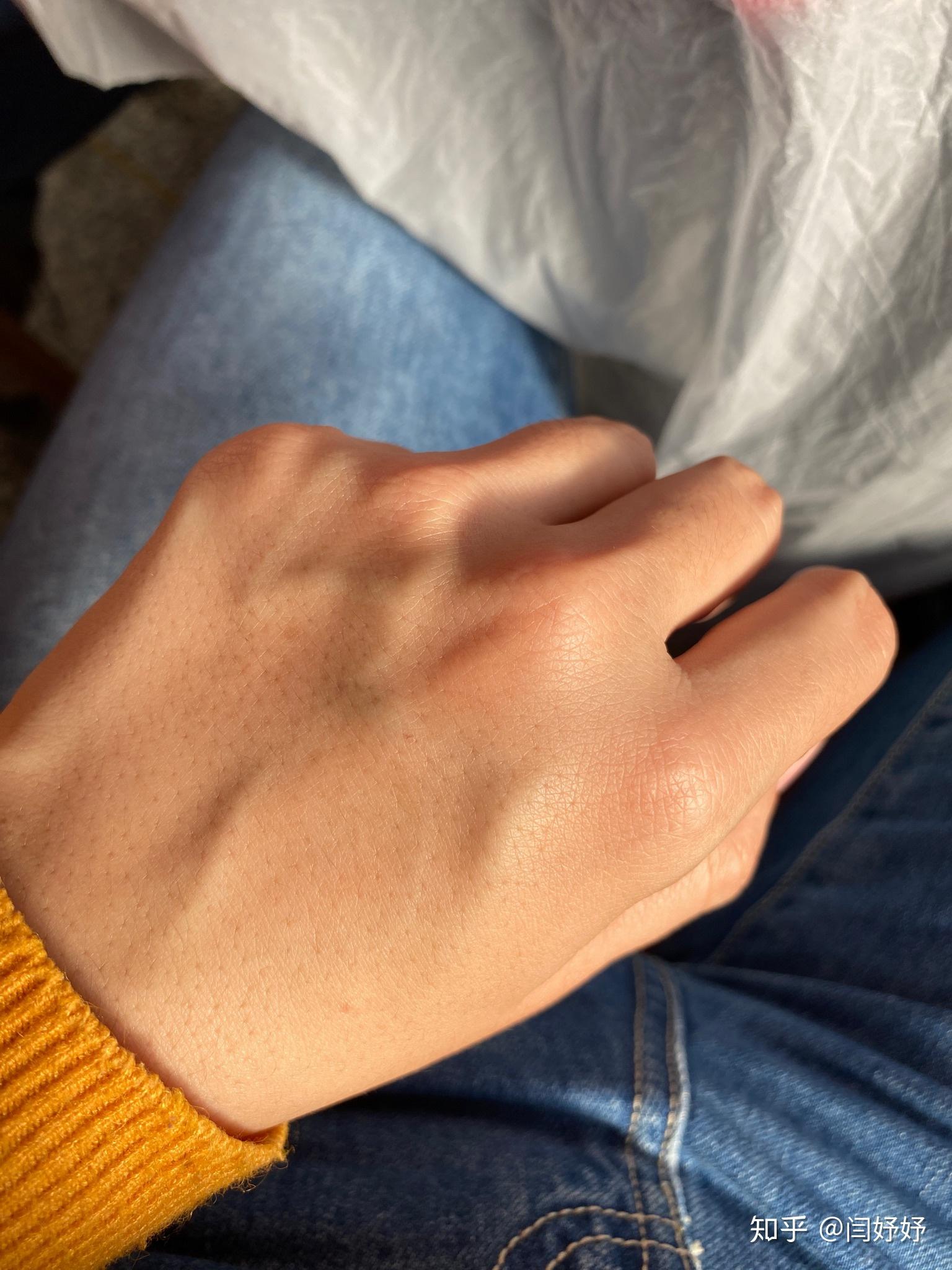 我一姑娘手青筋这般凸爆以后会越来越严重吗