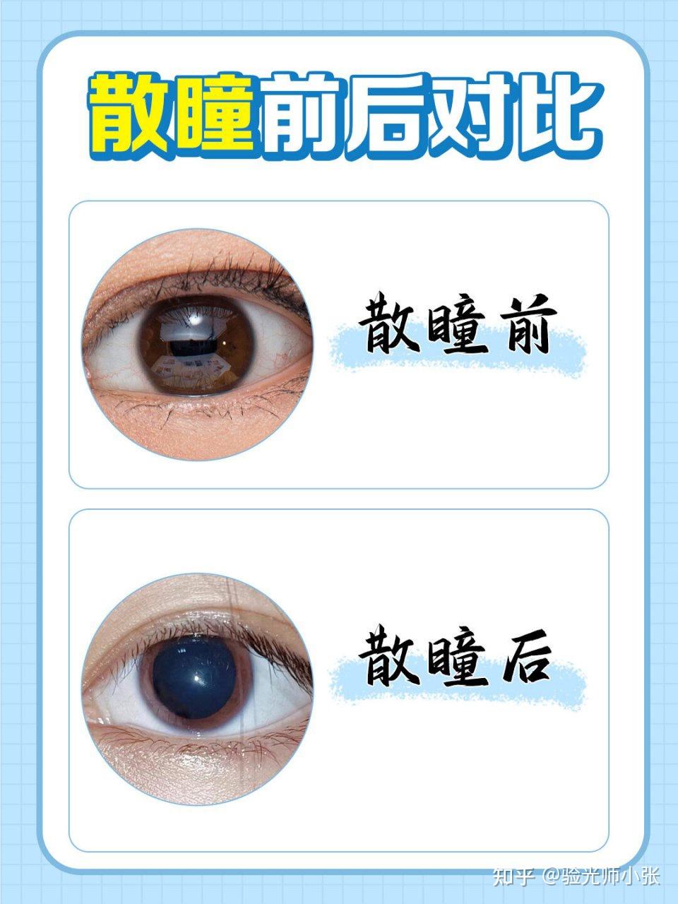 散瞳的几种形式 - 知乎