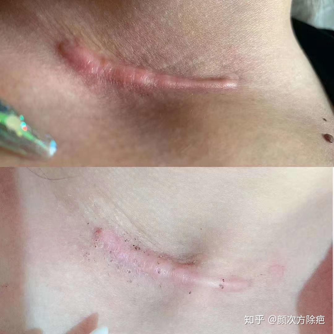 我想问一下,我的脖子上有一个大概五厘米长的手术疤,会导致教师资格证