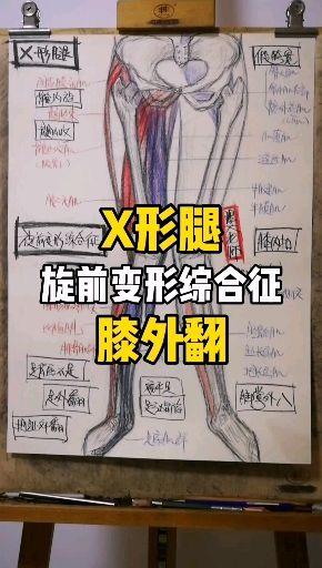 【xo型腿1】跟骨外翻 脛骨內旋【xo型腿2和3】【足內翻/跟骨內翻】