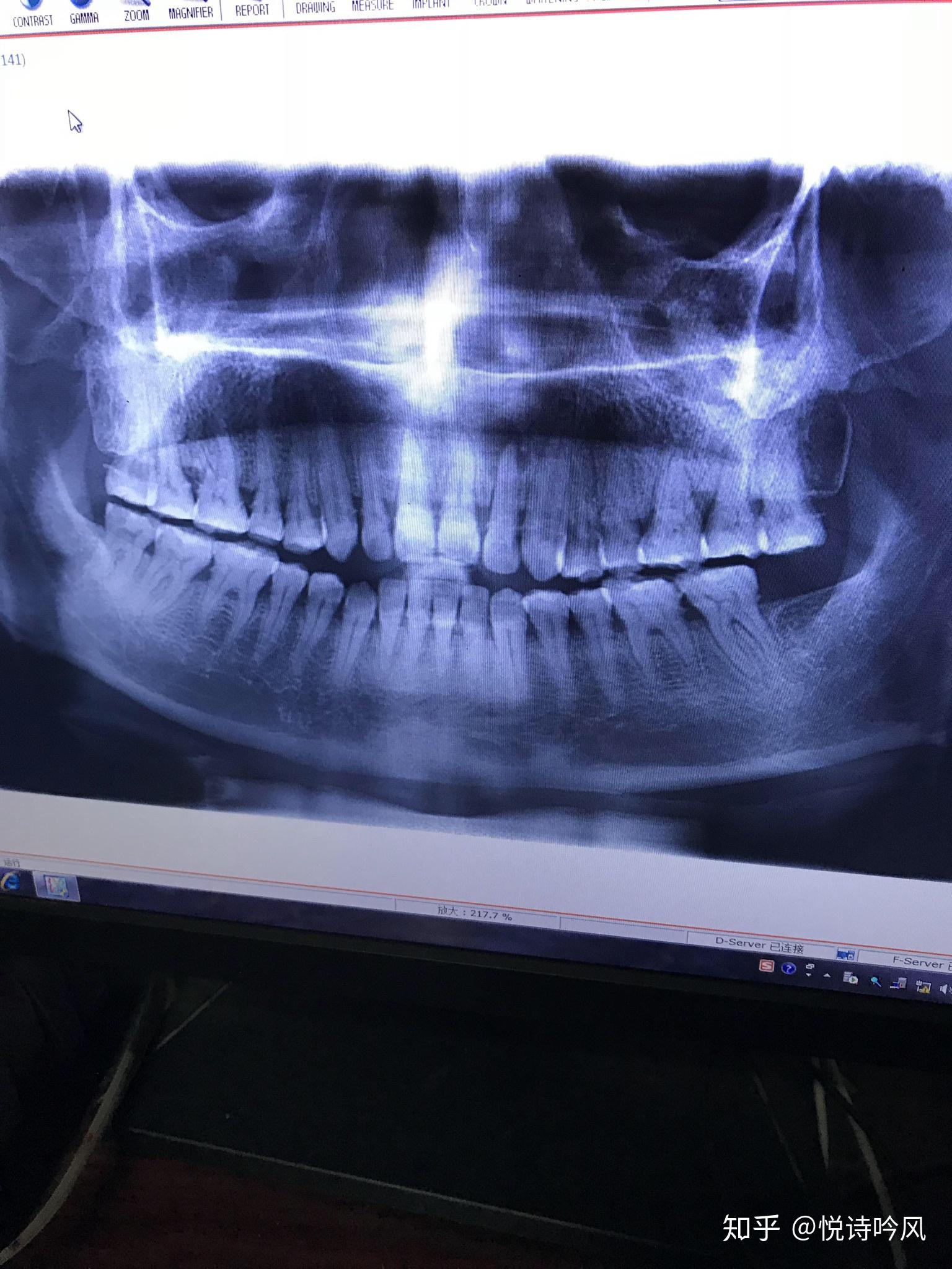 健康牙齿全景片的图片,正常牙齿健康牙齿图片,健康的牙齿和蛀牙图片(第2页)_大山谷图库