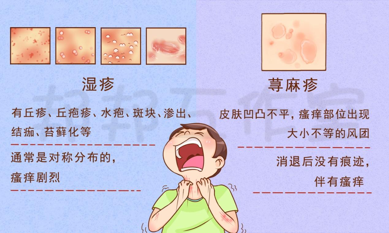 如何区分寻麻疹和湿疹? - 知乎