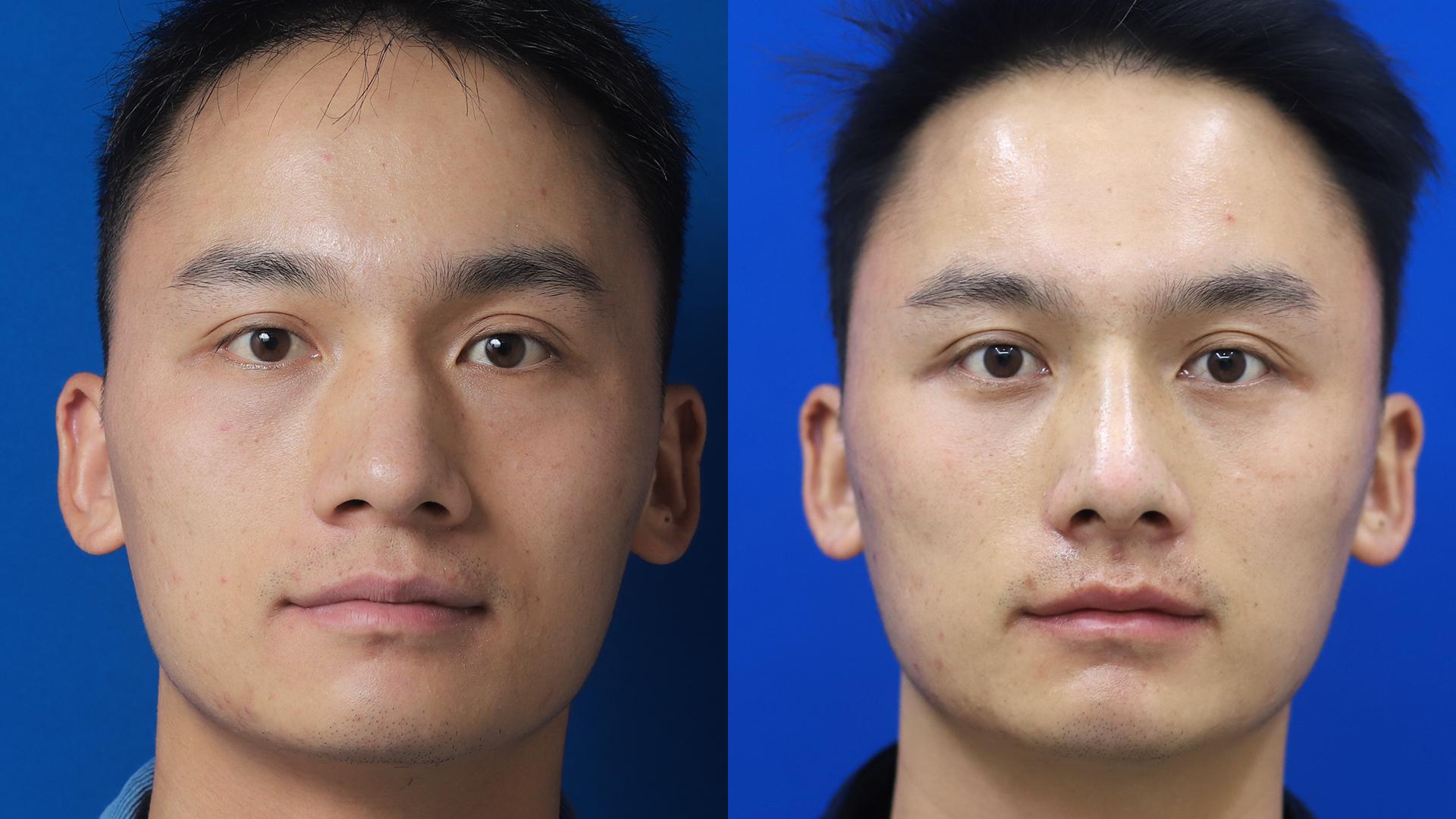 鼻骨内推,一般能达到的效果如何?