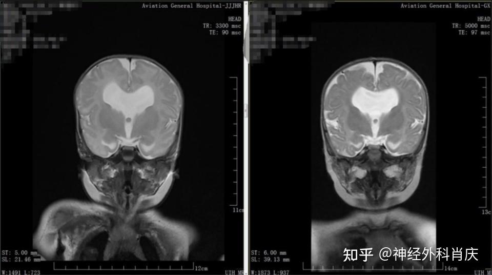 航空总医院肖庆运用软性神经内镜微创技术，为双胞胎脑积水患儿点亮生命奇迹 - 知乎