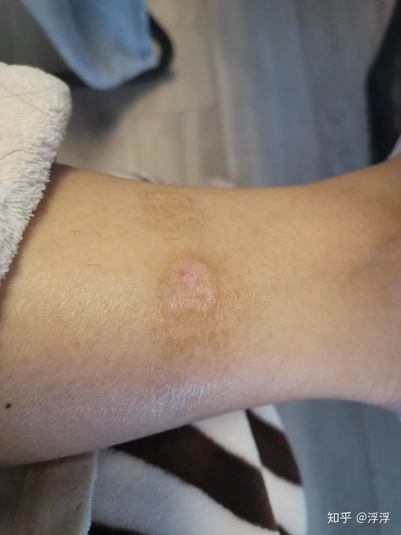 艾灸烫伤没有戳破,多长时间能恢复? - 知乎