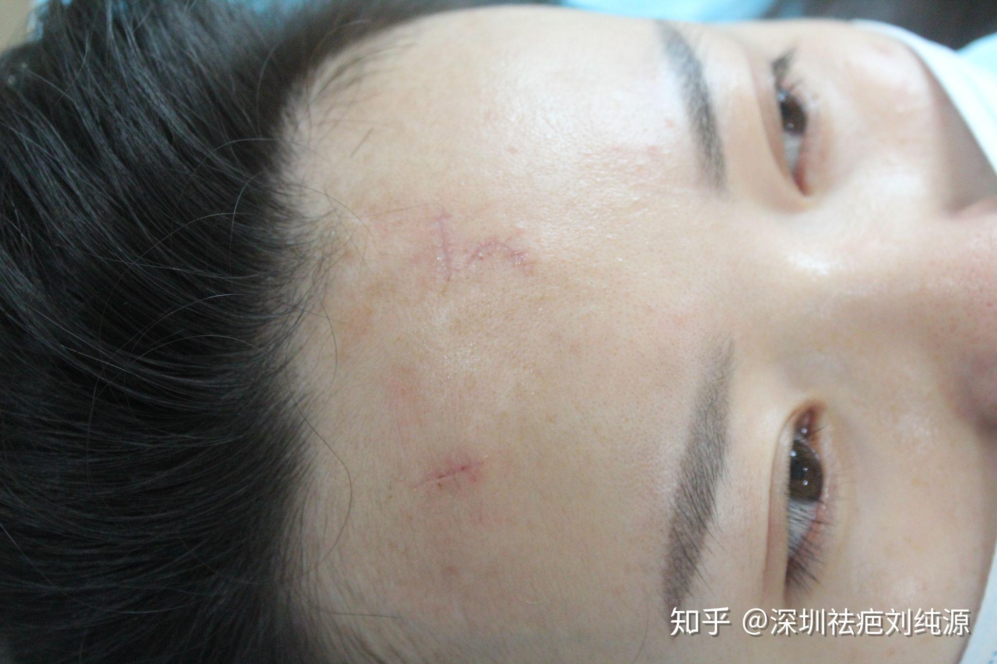 四五年前药水点痣后留下的疤痕还能去得掉么? - 知乎