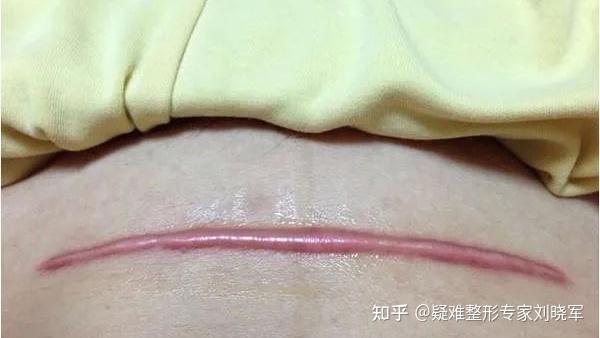 又痒又难看的剖腹产疤痕,可以通过这些方法改善 - 知乎