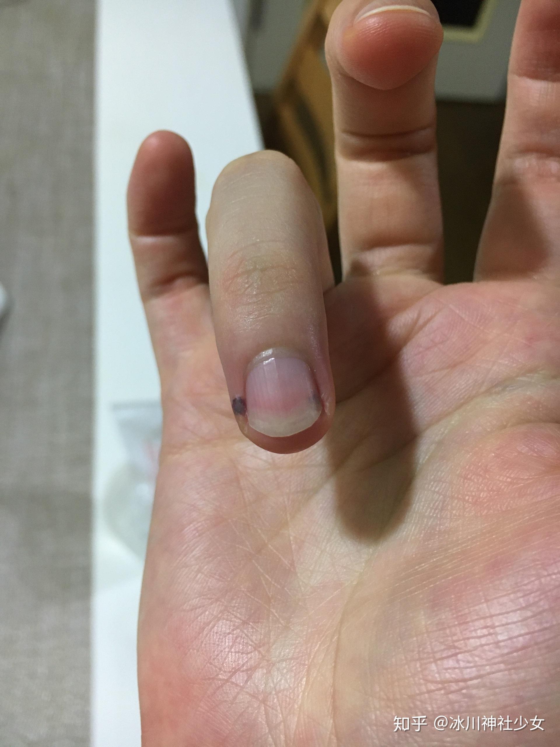 手指被夹紧急处理法方法 - 知乎