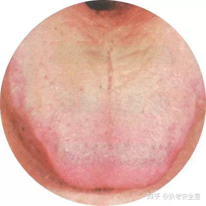 【舌诊大全】120种常见的舌苔超清彩色图谱,建议收藏! - 知乎