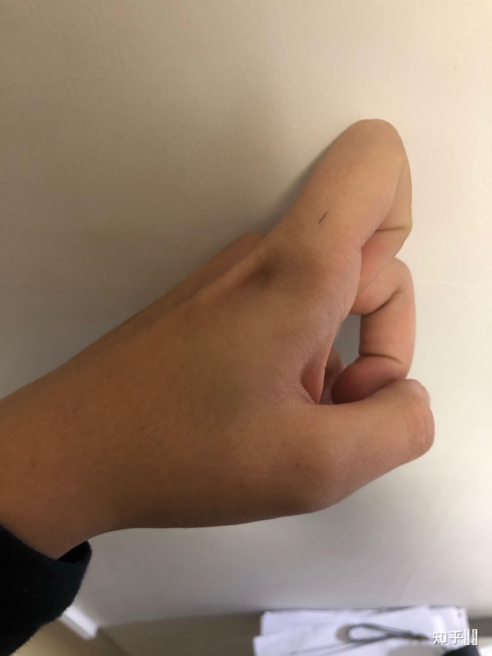 手指十个指头第一关节可反向弯曲90度正常吗