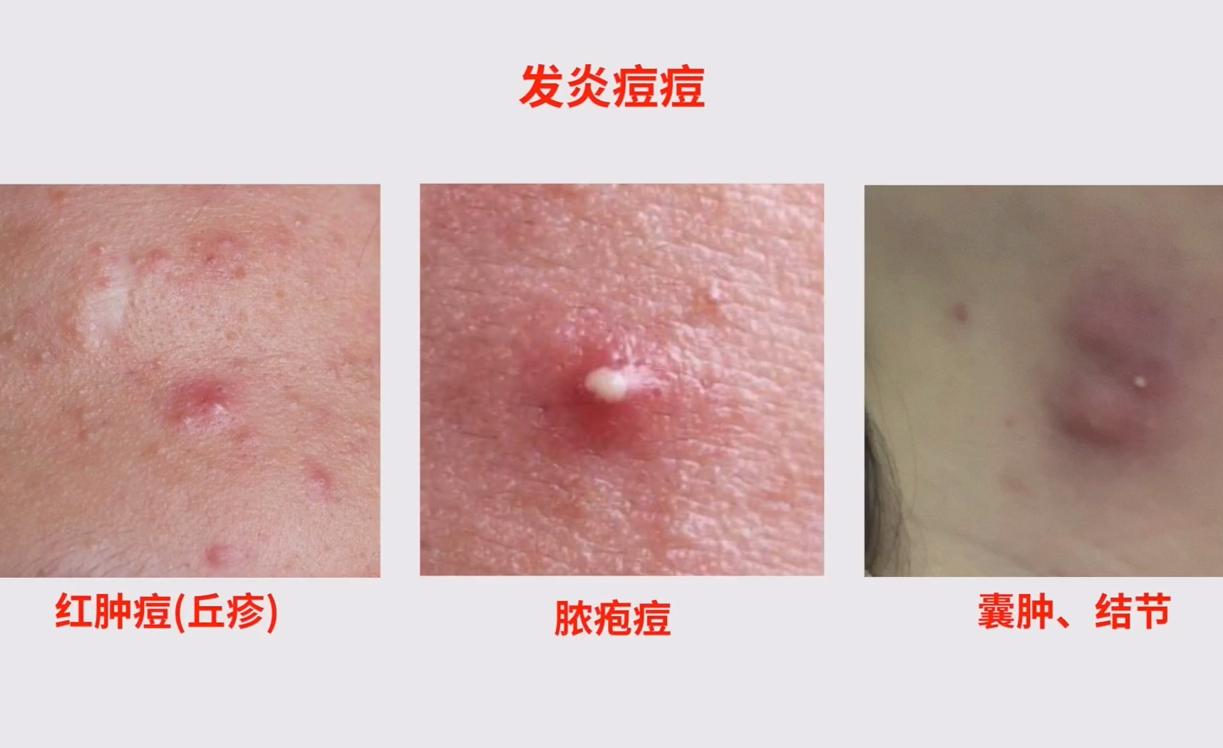「痘痘专题总」一篇文章讲清楚痘痘、痤疮的根源，以及如何治痘、抗痘、预防痘痘 | 红肿痘、脓包痘、囊肿结节 - 知乎