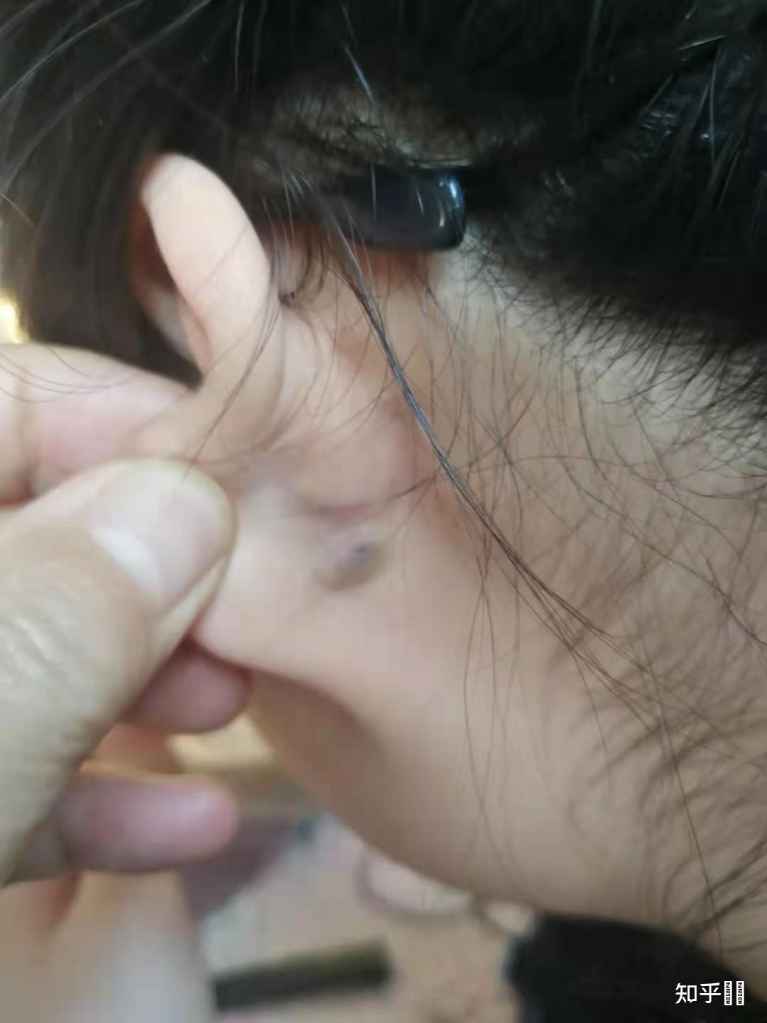 耳朵后面长了个硬包这是怎么回事