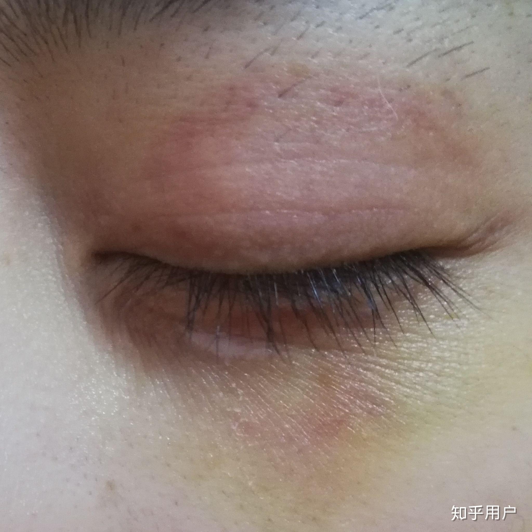 想知道眼部淤青怎么可以快速消除? - 知乎