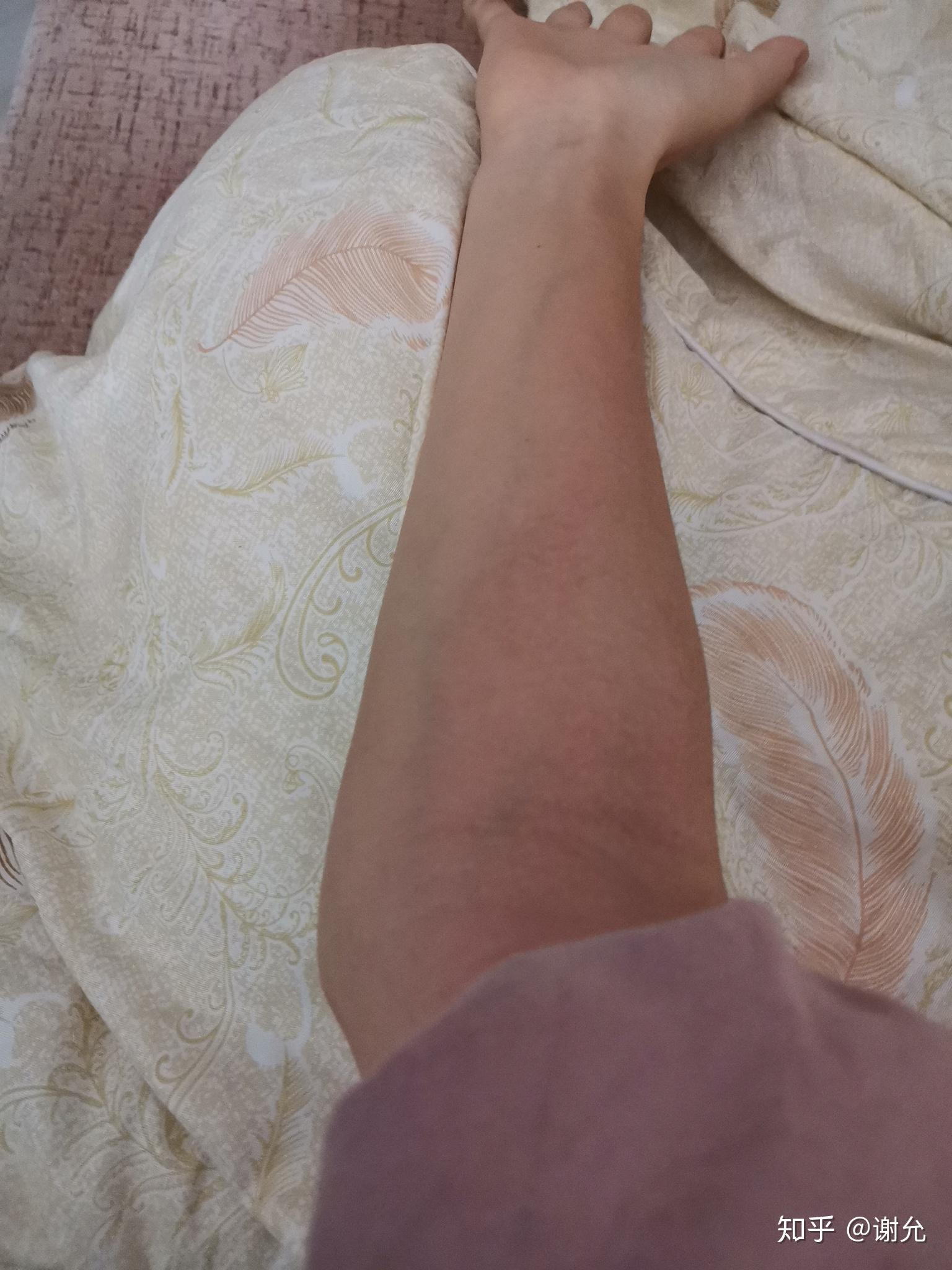 作为一个肘外翻/手肘超伸的女生是怎样一种体验? - 知乎