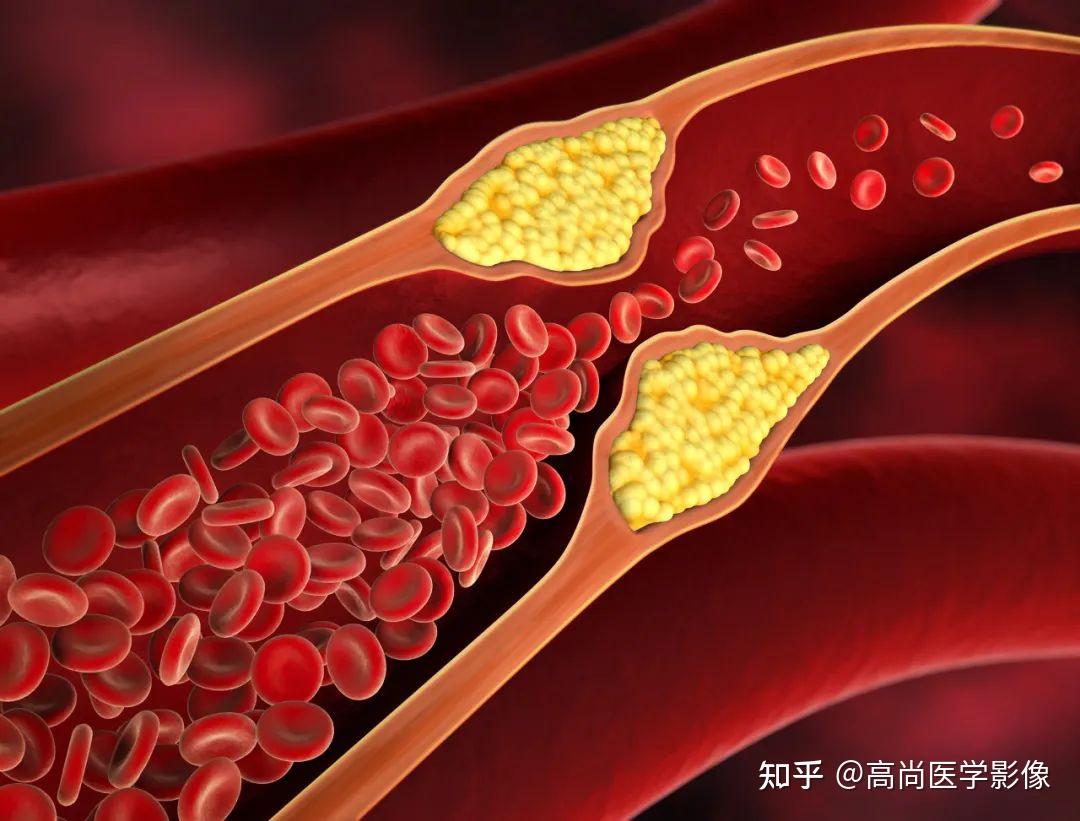 血管衰老与个体衰老的关系是什么? - 知乎