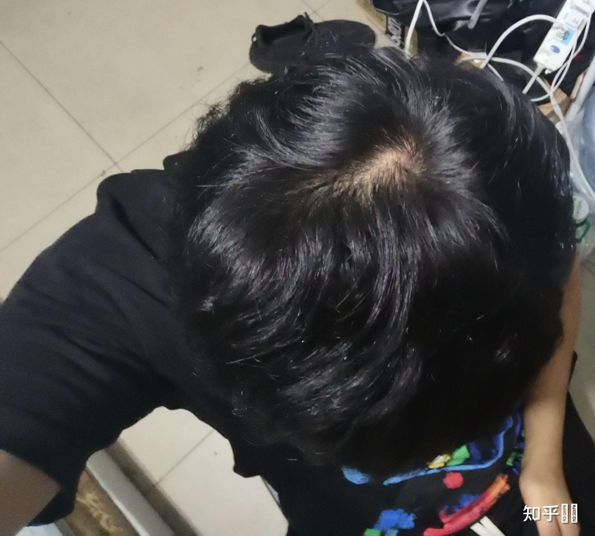 什么样子的发旋是正常的啊