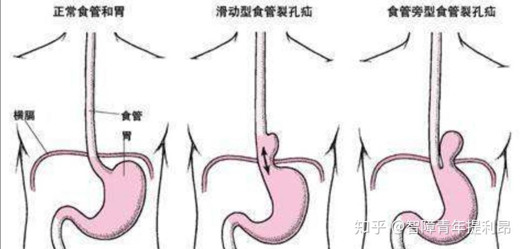 如果人突然没了横膈膜会怎样? - 知乎