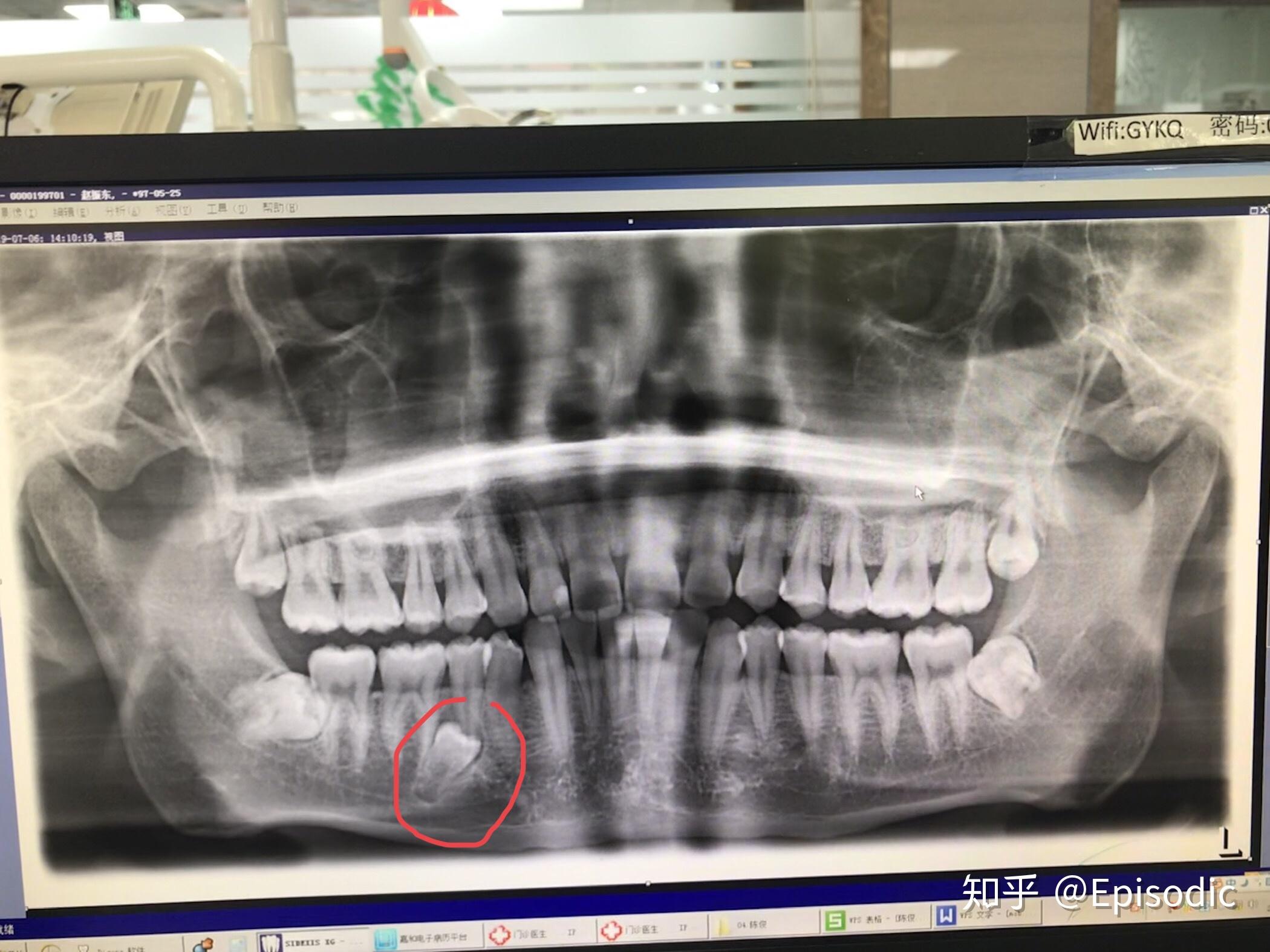 智齿该不该拔?