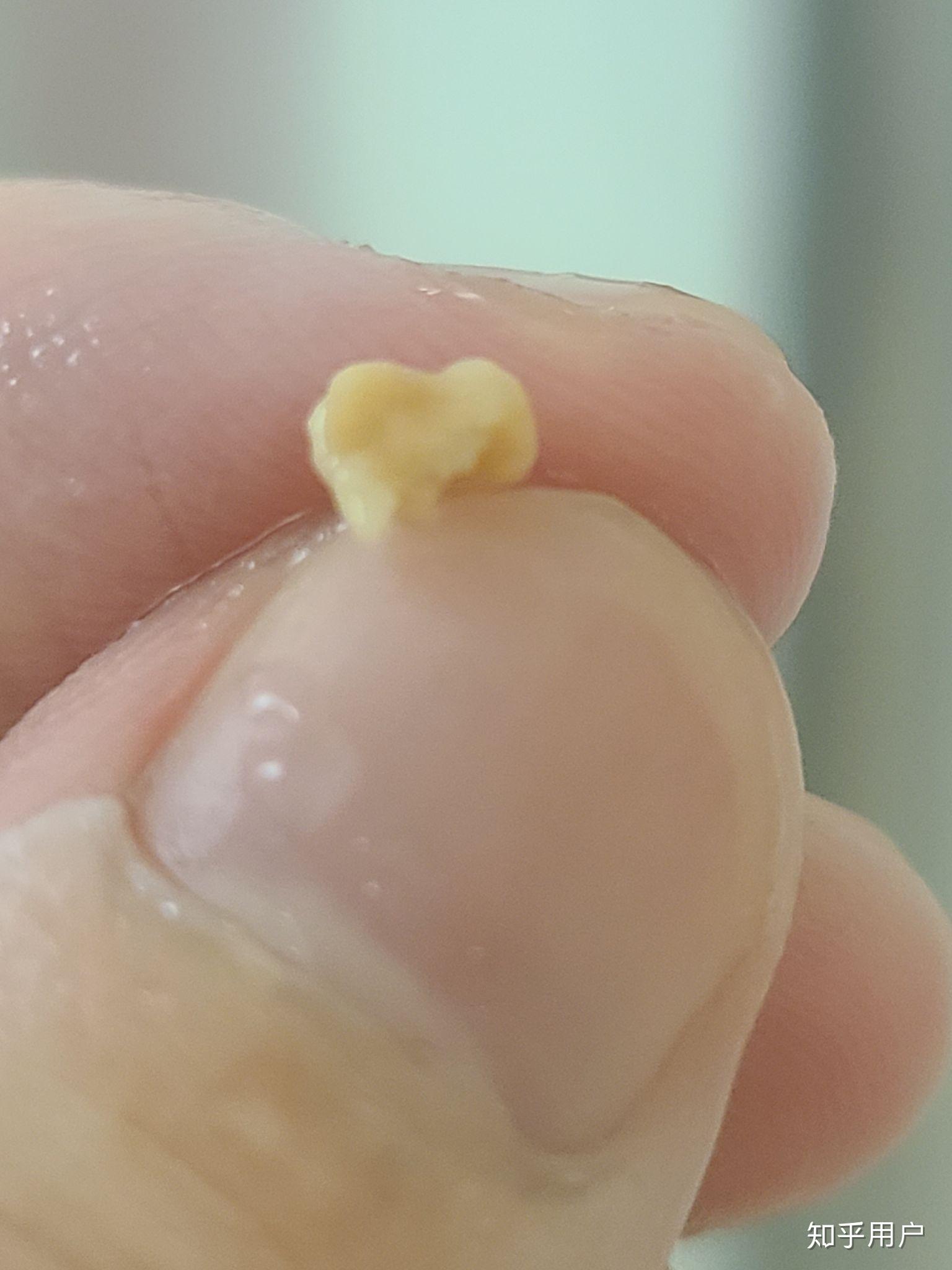 扁桃体结石能大到什么程度? - 知乎