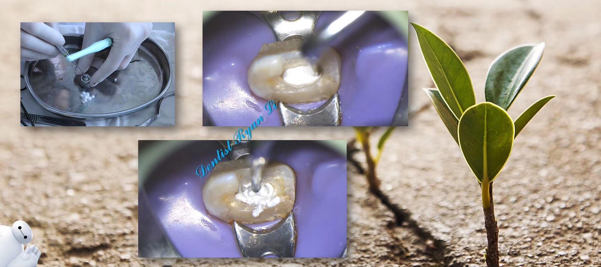 间接盖髓术成功率? - 知乎